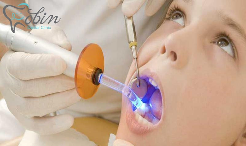 کامپوزیت برای کودکان فقط در دندانپزشکی کودکان انجام گردد